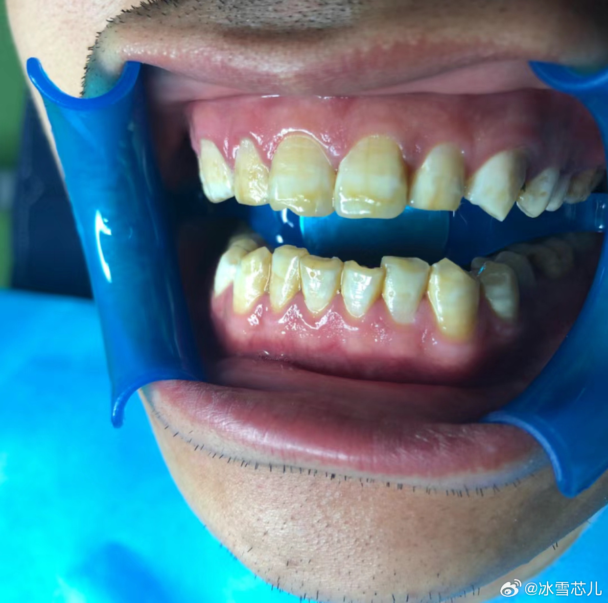 四環(huán)素牙貼面價格解析與比較指南